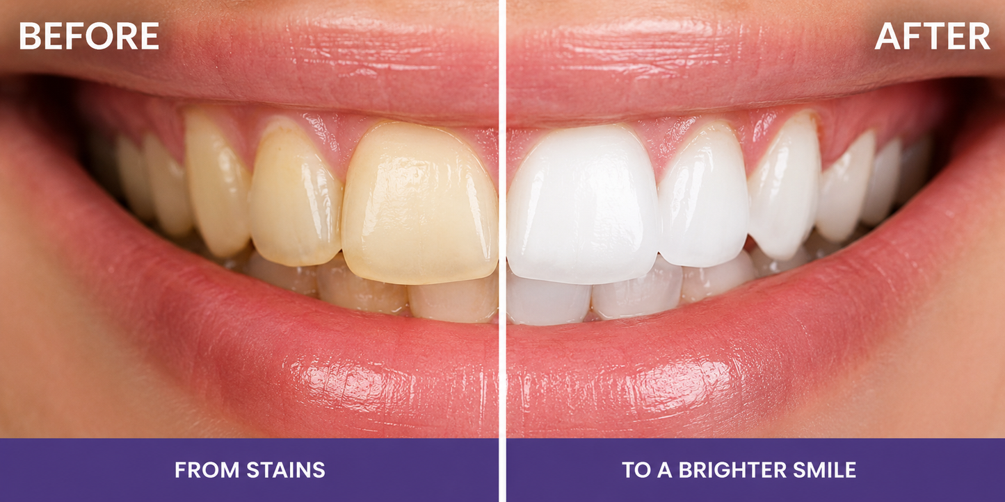 Whiten Your Teeth Up To 8 Shades In 14 Days DentiRestore Teeth Whitening Strips